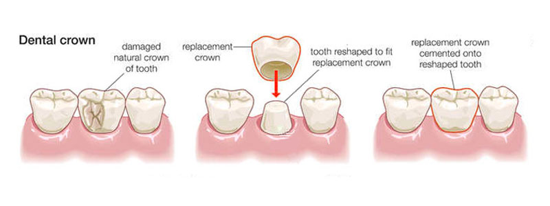 Dental Crown